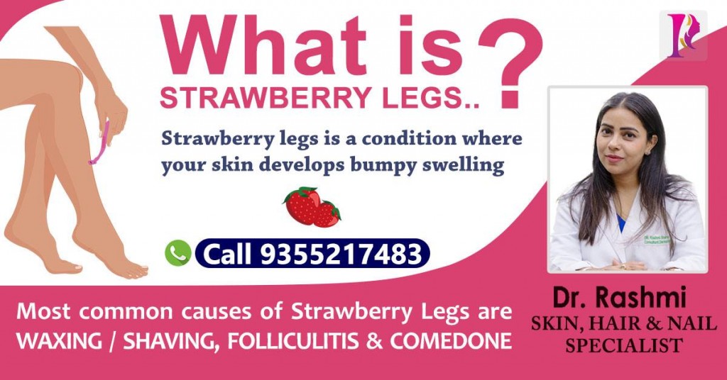 Strawberry Legs treatment by Dr Rashmi Sharma, Skin Hair Nail Specialist at Vasant Kunj, New Delhi